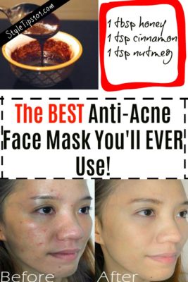 best acne face mask