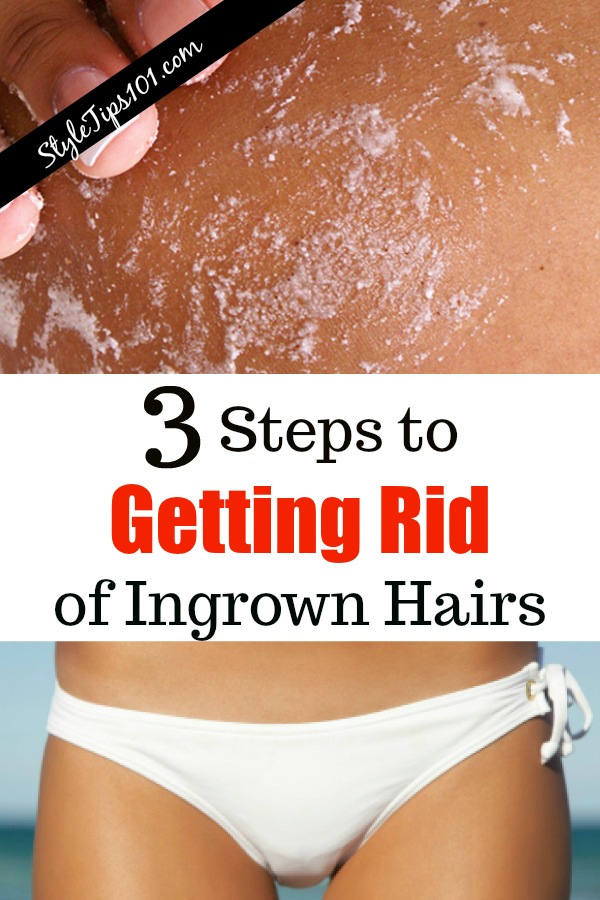 Getting Rid of Ingrown Hairs