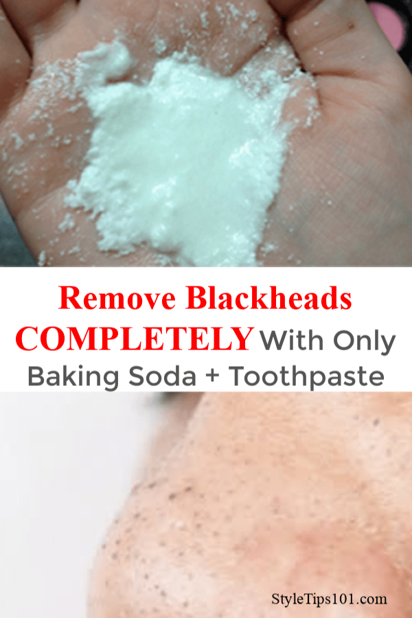 Remove Blackheads