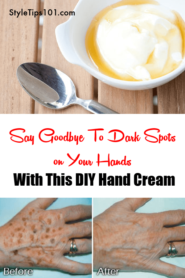 Dark Spots On Your Hands