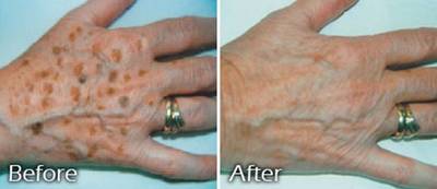 before and after liver spots on hands