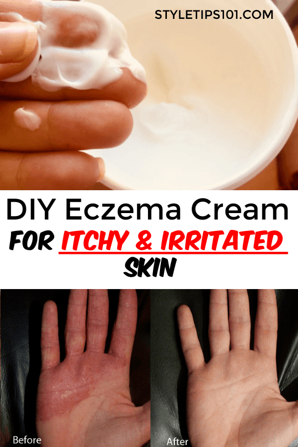 DIY Eczema Cream