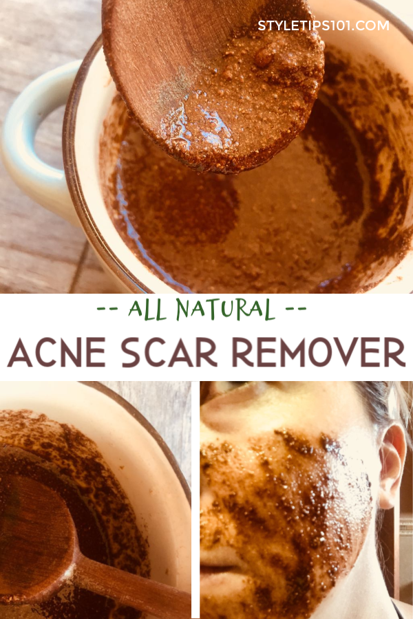 Natural Acne Scar Removal