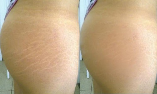 before-and-after-stretch-marks