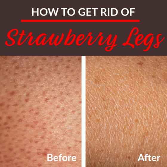 How To Get Rid Of Strawberry Legs 