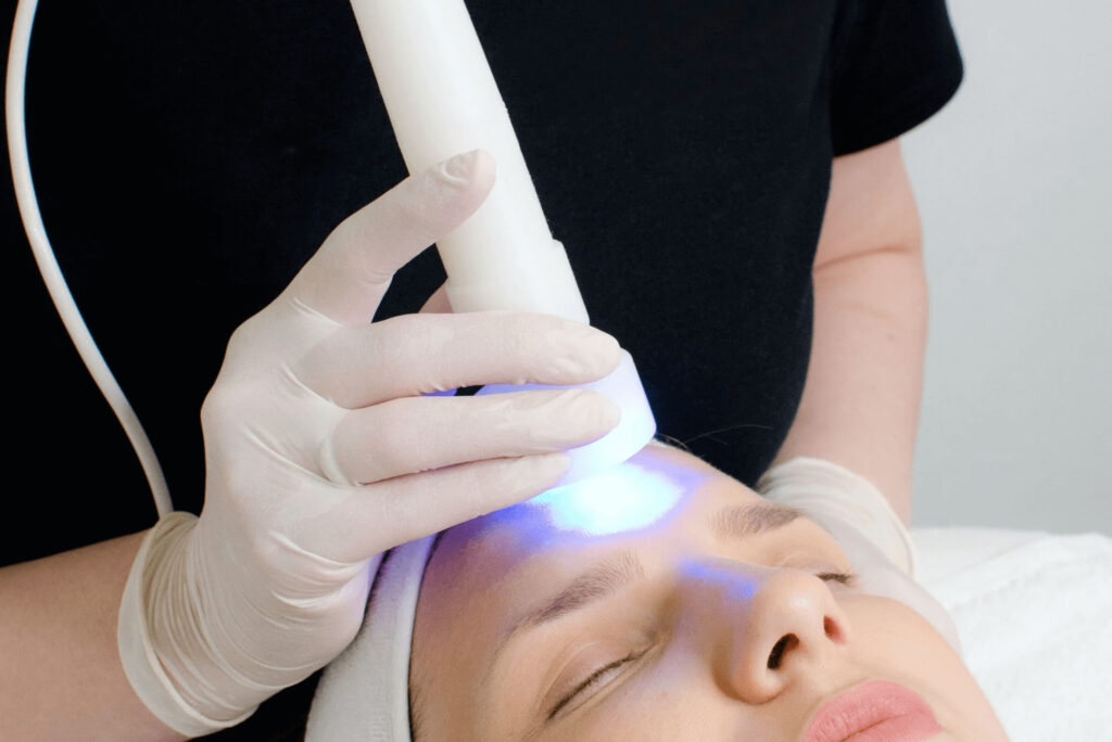 light therapy for acne