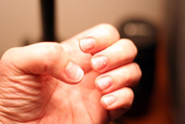 what causes brittle nails