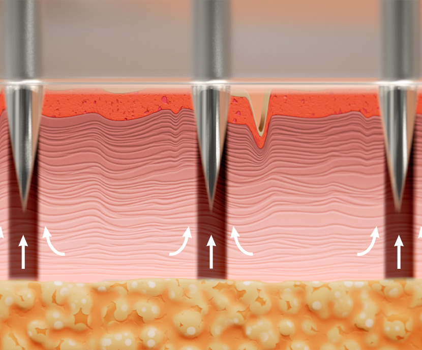 micro-coring