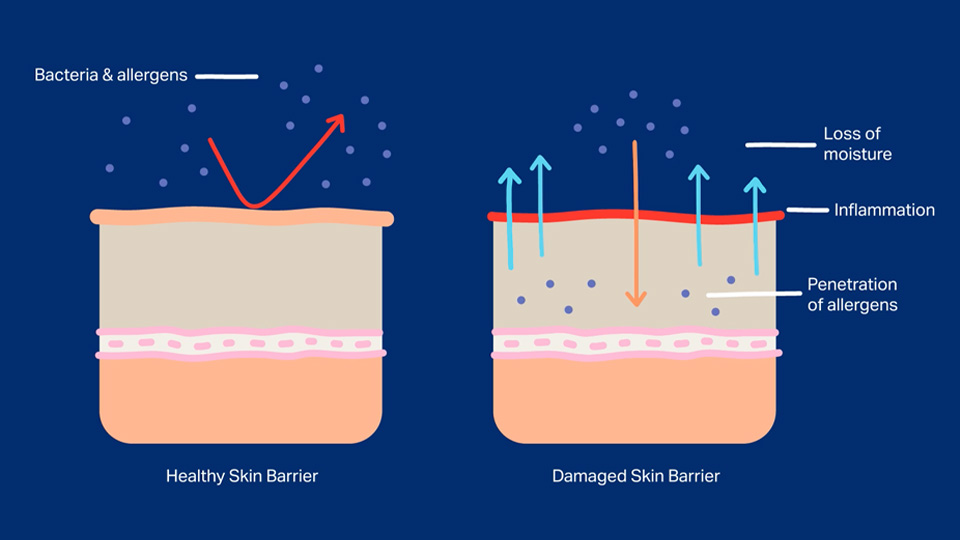 skin's lipid barrier